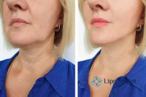 Double chin before and after Hi-Fu treatment 4 Book your double chin treatment Abingdon today! We are here to help!