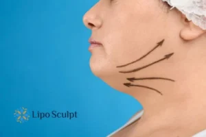 Double chin before and after Hi-Fu treatment 3 Boost your confidence with a Double chin treatment Abingdon