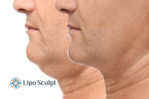 Double chin before and after Hi-Fu treatment 2 Double chin treatment Abingdon from Lipo Sculpt - feel more confident today!