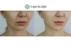 Explaining Total Skin Tightening Treatment And What It Can Do For You 2 Do you want to boost your self confidence? Give Morpheus8 Abingdon a try today!