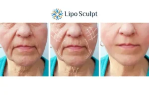 Explaining Total Skin Tightening Treatment And What It Can Do For You 3 Boost your confidence with Morpheus8 Abingdon call our team today!