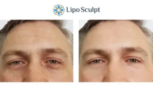 Explaining Total Skin Tightening Treatment And What It Can Do For You 6 Morpheus8 Abingdon book in today to find out more!