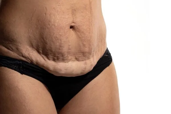 Lost the Weight but Not the Loose Skin? 1 image of womans stomach after weight loss showing loose skin Abingdon